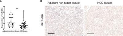 MicroRNA-20a Suppresses Tumor Proliferation and Metastasis in Hepatocellular Carcinoma by Directly Targeting EZH1